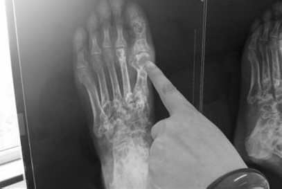 段如仁的X光片显示,其左脚大拇指处痛风石较为严重 段如仁的X光片显示,其左脚大拇指处痛风石较为严重