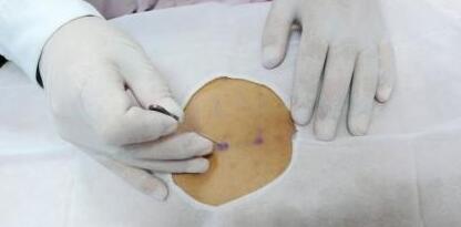 强直性脊柱炎的小针刀疗法 强直性脊柱炎的小针刀疗法