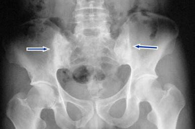 少时贪凉过度 无奈人到中年还受强直之苦 少时贪凉过度 无奈人到中年还受强直之苦
