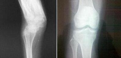 ���ʪ6����֣��ʹ���ʪ��ҽԺ��ʪ�����ƺ� 