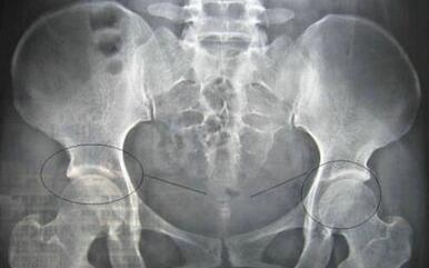 治疗强直曲折路 在郑州痛风风湿病医院风湿科终结 治疗强直曲折路 在郑州痛风风湿病医院风湿科终结