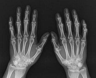 创业期条件艰苦,不幸患上了类风湿 创业期条件艰苦,不幸患上了类风湿