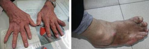 Ϊ��ʹ�� Ľ������֣��ʹ���ʪ��ҽԺ