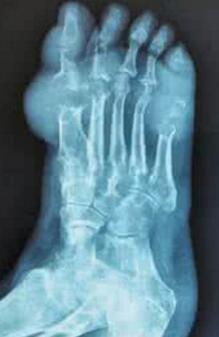 郑州市哪家医院可以切除痛风石 郑州市哪家医院可以切除痛风石