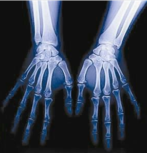 老大爷遇良医 类风湿终