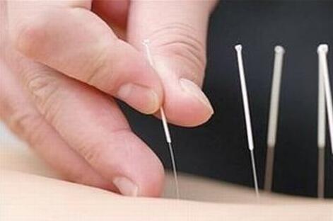 针灸治疗风湿性关节炎 吗