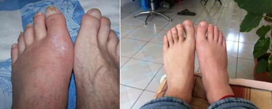 痛风多年吃药渡过 病痛难忍欲自杀 痛风多年吃药渡过 病痛难忍欲自杀