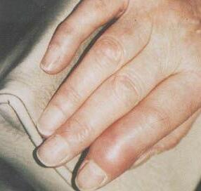 痛风多年遭漠视 终致手足严重变形