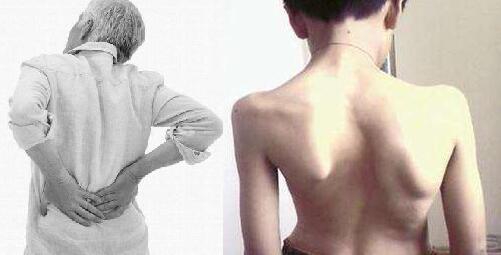 郑州强直医院:90%强直性脊柱炎会遗传 男性比女性居多 郑州强直医院:90%强直性脊柱炎会遗传 男性比女性居多