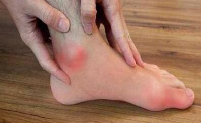 郑州治痛风医院哪家好,治疗方法 郑州治痛风医院哪家好,治疗方法