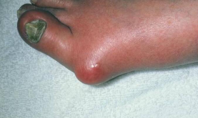 真实案例:骨头竟被痛风石“吃”了! 真实案例:骨头竟被痛风石“吃”了!