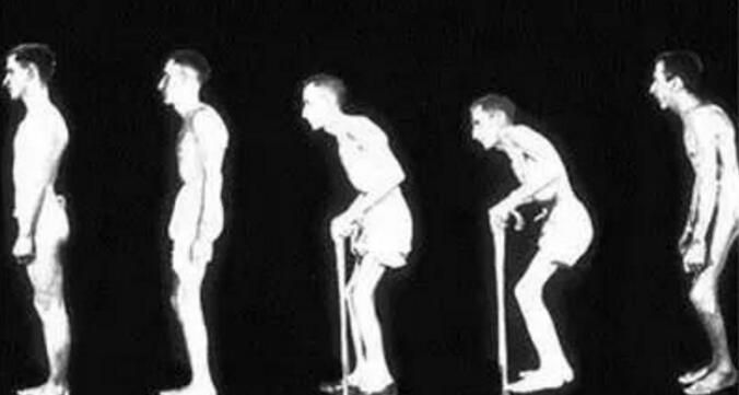 什么是强直性脊柱炎 什么是强直性脊柱炎