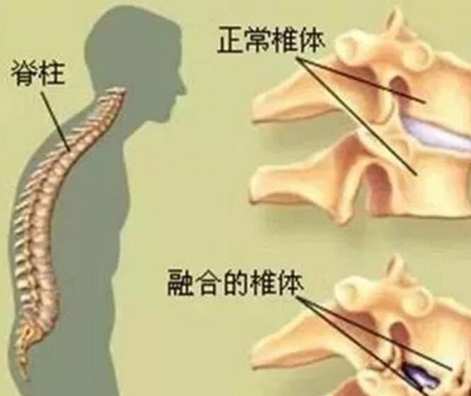 强直性脊柱炎为什么会出现驼背 强直性脊柱炎为什么会出现驼背