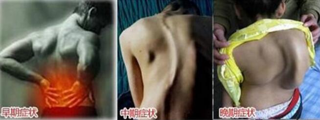 郑州强直专科医院,中晚期的强直性脊柱炎病变以脊柱受损为主 郑州强直专科医院,中晚期的强直性脊柱炎病变以脊柱受损为主