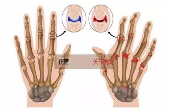治疗类风湿病的三大误区 治疗类风湿病的三大误区.jpg