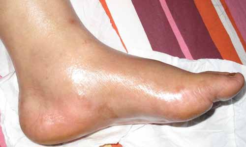 郑州痛风风湿病医院.jpg 郑州痛风风湿病医院