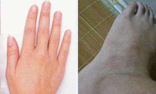 郑州痛风风湿病医院.jpg 郑州痛风风湿病医院