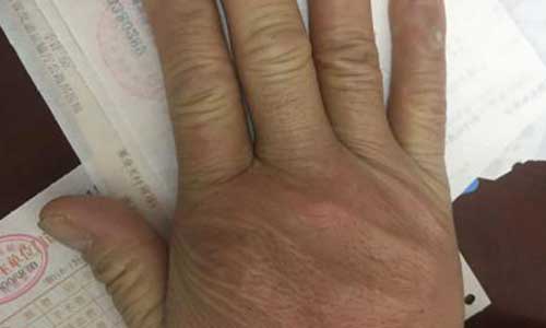 郑州痛风风湿病医院.jpg 郑州痛风风湿病医院