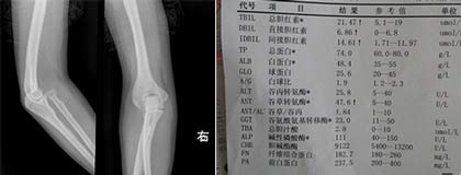 郑州痛风风湿病医院患者的CT检查及化验单.jpg 郑州痛风风湿病医院患者的CT检查及化验单