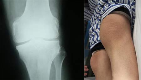 郑州痛风风湿病医院患者膝关节症状和X线片.jpg 郑州痛风风湿病医院患者膝关节症状和X线片