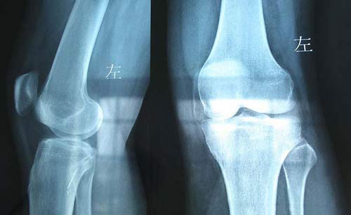 ֣��ʹ���ʪ��ҽԺ����CT���ϥ�ؽ�֢״