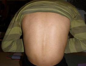 郑州痛风风湿病医院强直患者治疗前脊柱症状.jpg 郑州痛风风湿病医院强直患者治疗前脊柱症状