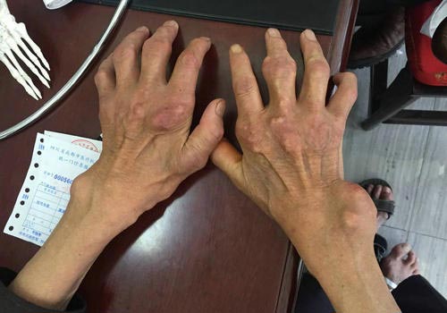 郑州痛风风湿病医院.jpg 郑州痛风风湿病医院