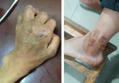 郑州痛风风湿病医院.jpg 郑州痛风风湿病医院