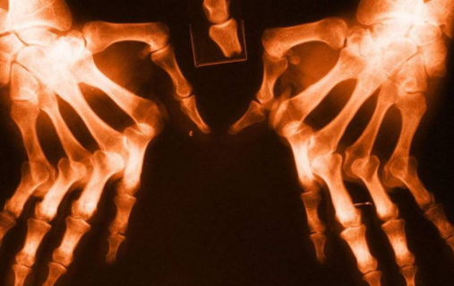 手麻是类风湿引发的吗?郑州内风湿病医院 郑州内风湿病医院.png