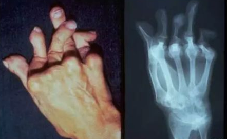 类风湿很可怕吗?郑州治内风湿医院 郑州治内风湿医院.png