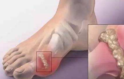 早疾病一步知道痛风的前兆,就早一步治疗疾病 早疾病一步知道痛风的前兆,就早一步治疗疾病.png