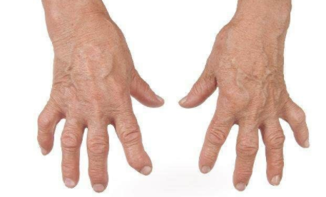 类风湿有哪些危害?郑州治内风湿病医院 郑州治内风湿病医院.png