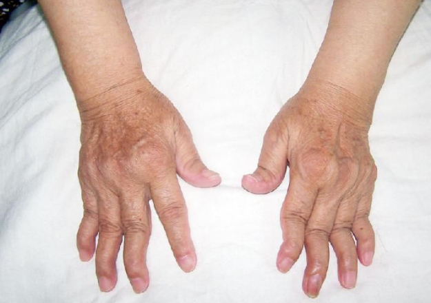 类风湿关节炎在日常生活中需要如何护理?郑州治疗类风湿关节炎医院 郑州治疗类风湿关节炎医院.png