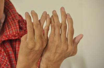 类风湿性关节炎症状的表现有哪些?郑州专业类风湿医院 郑州专业类风湿医院.png